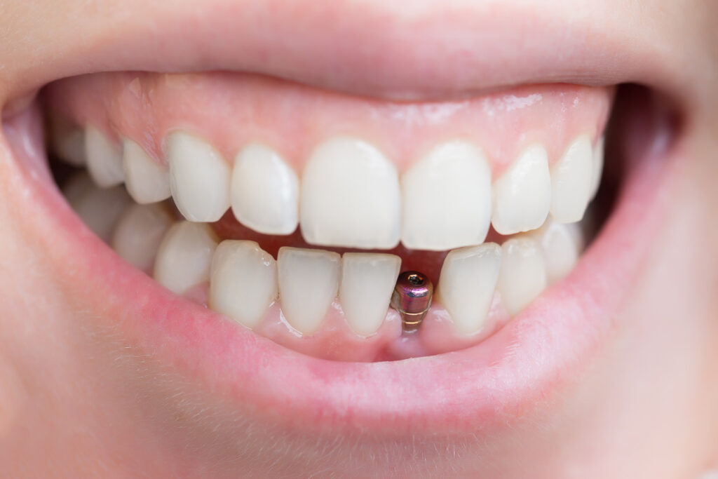 on dis implant nedir