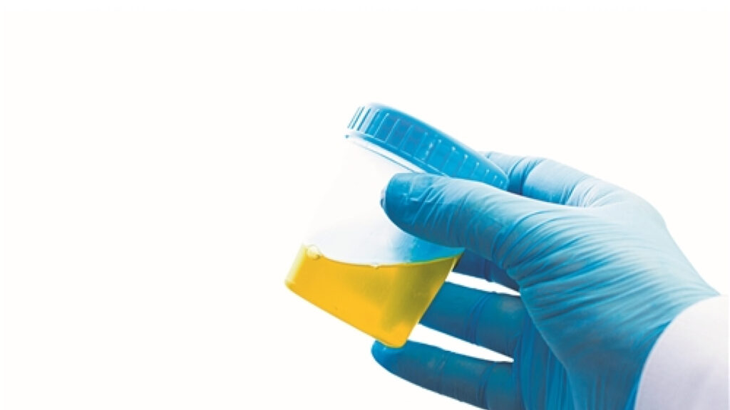 cocuklarda idrar tahlili