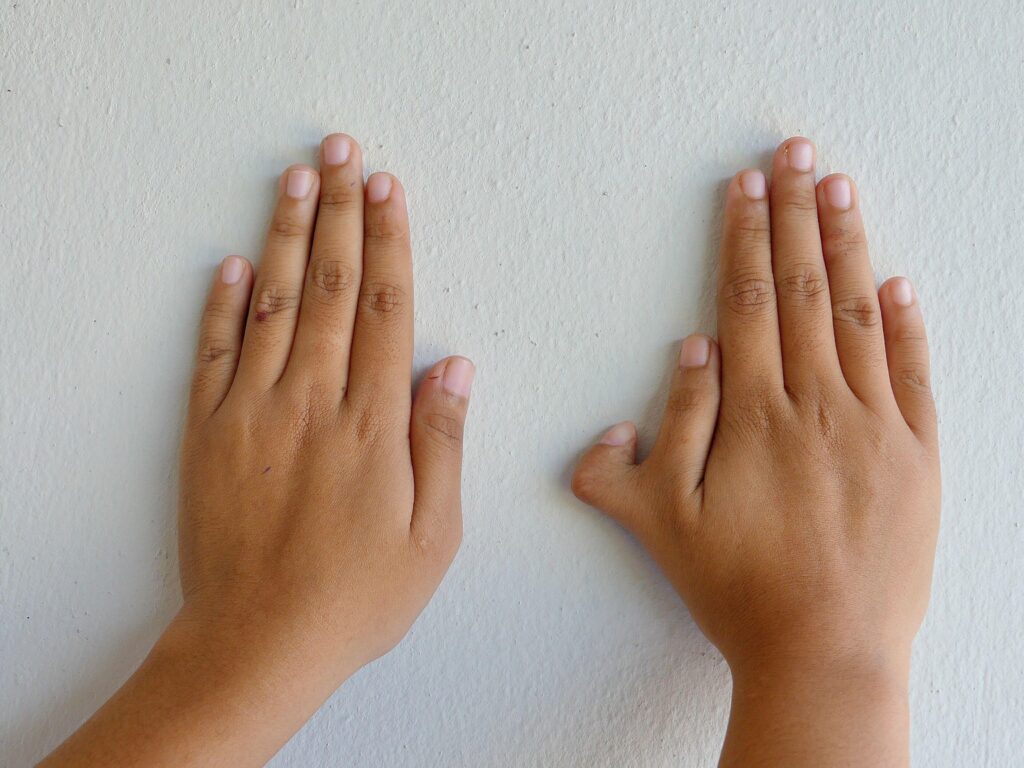polidaktili ameliyati 2